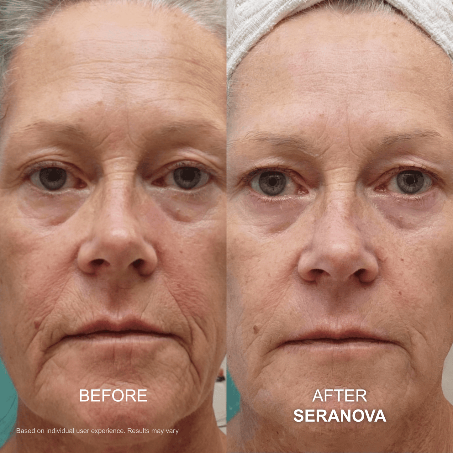 The Micro Infusion Syste