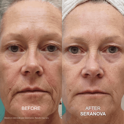 The Micro Infusion Syste