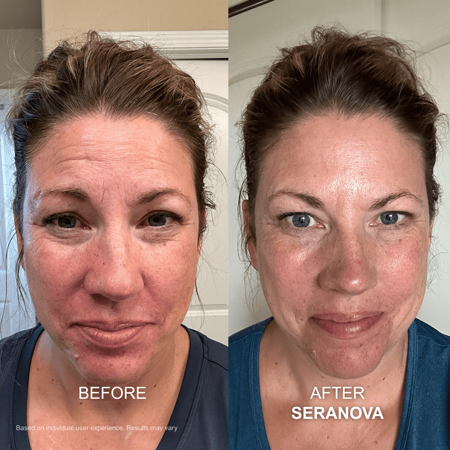 The Micro Infusion Syste